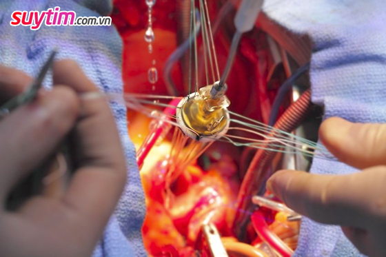 Phẫu thuật sửa van tim được tiến hành khi van tim bị tổn thương nặng 