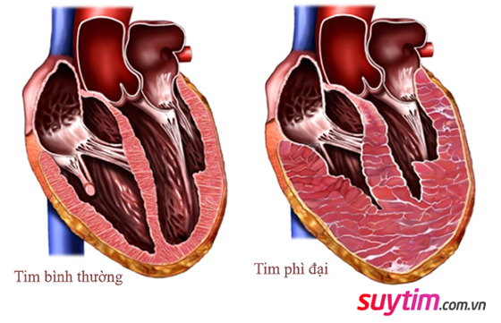 Hình ảnh trái tim bình thường và trong bệnh cơ tim phì đại