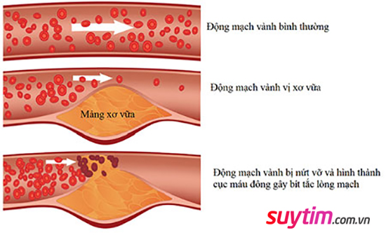 Bệnh mạch vành xảy ra là do sự xuất hiện các mảng xơ vữa trong lòng động mạch vành