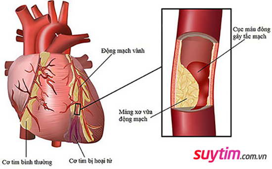Cơn nhồi máu cơ tim ở người bệnh mạch vành là con đường dễ dẫn tới suy tim.