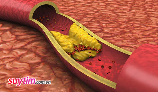 Mảng xơ vữa nứt vỡ là yếu tố tăng nguy cơ hình thành cục máu đông gây nhồi máu cơ tim