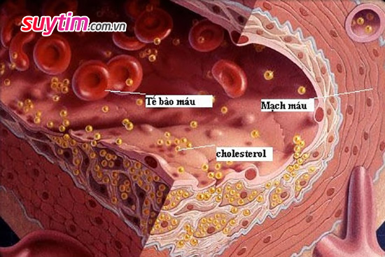 Cholesterol cao là nguyên nhân gây xơ vữa động mạch