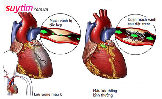 Phương pháp đặt stent mạch vành thường được chỉ định trong điều trị thiếu máu cơ tim