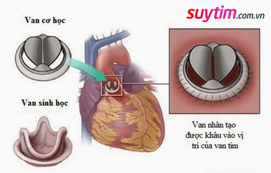 Thay van tim là chỉ định phổ biến trong điều trị bệnh van tim