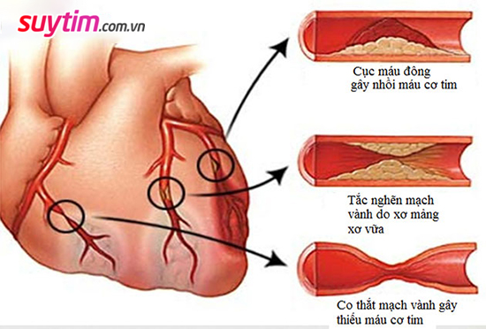 Hình ảnh tim và các hình thái của động mạch vành gây thiếu máu cơ tim, nhồi máu tim