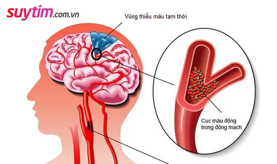 Cục máu đông có thể di chuyển đến tim và não gây tử vong