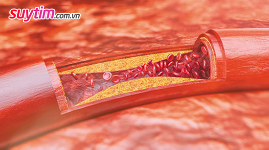 Mảng cholesterol bám dính vào thành mạch máu và gây chít hẹp mạch máu