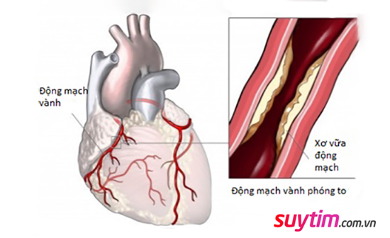 Xơ vữa động mạch vành