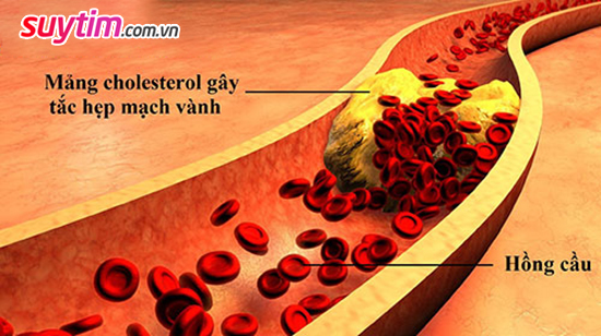 Cholesterol máu cao là thủ phạm gây tắc hẹp mạch vành, thiếu máu cơ tim