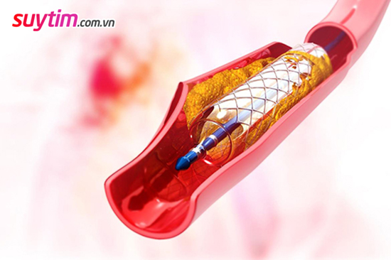   Can thiệp mạch vành đặt stent đang được áp dụng rộng rãi