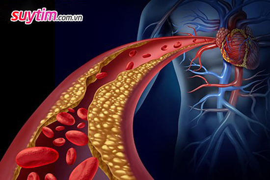 Thiếu máu cơ tim không chỉ do xơ vữa mạch vành mà có thể là do bệnh vi mạch vành