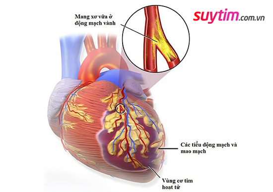 Thiếu máu cơ tim do bệnh vi mạch vành là do co thắt các tiểu động mạch và mao mạch