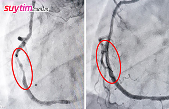 Chụp mạch vành có thể xem được rõ đoạn  mạch vành tắc, đoạn mạch vành bị dị dạng