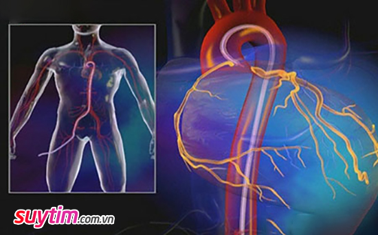 Chụp mạch vành qua da luồn một ống thông qua động mạch bẹn vào tới mạch vành tim