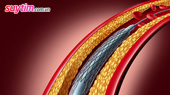 Đặt stent mạch vành - phương pháp có thể cứu lấy mạng sống người bệnh 