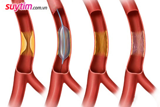 Nong mạch, đặt stent chỉ giúp thông thoáng mạch máu trong một thời gian nhất định 