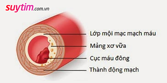 Động mạch vành bị tắc hẹp bởi mảng xơ vữa và cục máu đông