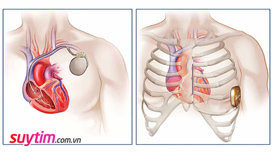 Phẫu thuật cấy máy ICD sẽ giúp người bệnh rối loạn nhịp tim duy trì nhịp tim ổn định.