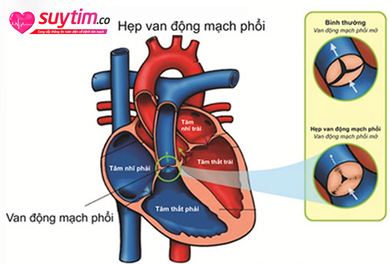 Van động mạch phổi mở không hết do hẹp làm giảm lượng oxy trong máu