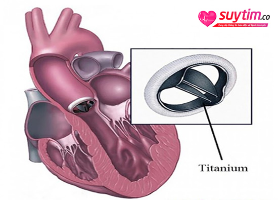 Van tim cơ học được sử dụng rất phổ biến trong phẫu thuật thay van tim