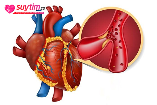 Hơn 40% cả tử vong liên quan đến tim mạch xuất phát từ bệnh thiếu máu cơ tim