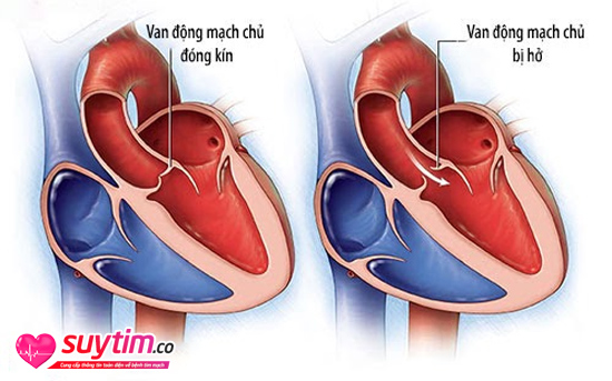 Hở van động mạch chủ làm máu trào ngược về tim và gây nguy hiểm cho tim
