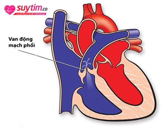 Hở van động mạch phổi sẽ khiến lượng máu bơm từ tim lên phổi bị thiếu hụt