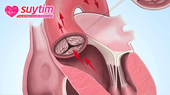 Vôi hóa van tim là nguyên nhân thường gặp dẫn đến hẹp van động mạch chủ