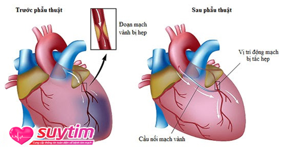 Phẫu thuật bắc cầu động mạch vành