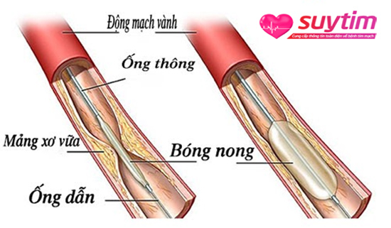 Hình ảnh mô tả quá trình nong mạch vành điều trị tắc nghẽn mạch vành