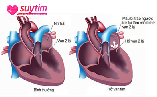 Mổ hở van tim có nguy hiểm không là băn khoăn của nhiều người bệnh