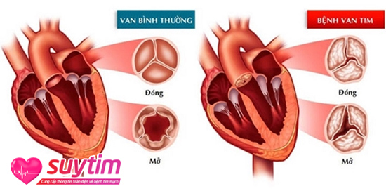 Bệnh van tim thường gặp là hẹp, hở van tim