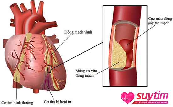 Cholesterol là yếu tố làm tăng nguy cơ bệnh mạch vành