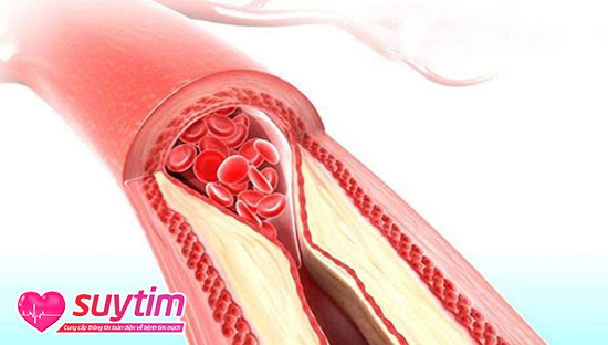 Các mảng xơ vữa mạch vành làm giảm lưu lượng máu đến nuôi tim