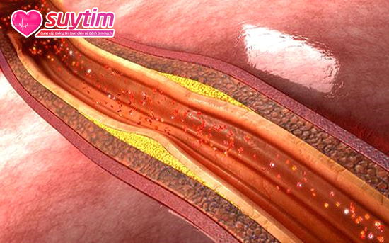 Bệnh mạch vành xảy ra là do mảng xơ vữa gây tắc nghẽn động mạch