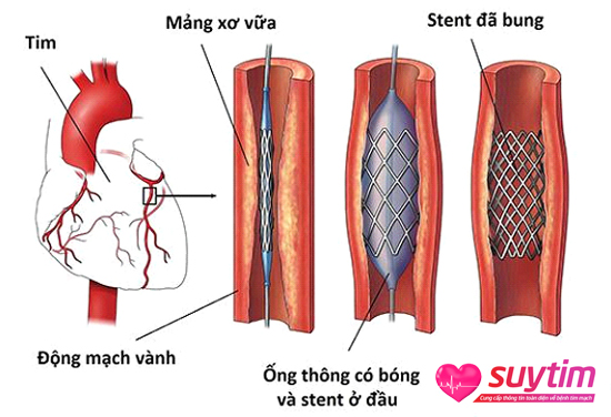 Hình ảnh đặt stent mạch vành.
