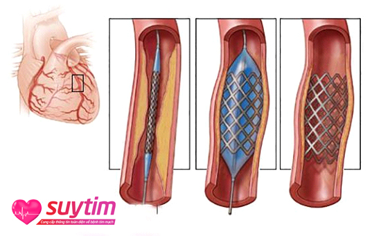 Can thiệp nong mạch và đặt stent là một cách điều trị xơ vữa mạch vành hiệu quả