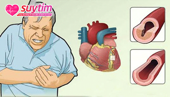 Thiếu máu cơ tim cục bộ thường gây ra các cơn đau thắt ngực
