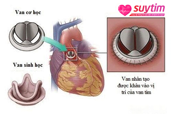 Phẫu thuật hở thay van tim áp dụng khi điều trị nội khoa không hiệu quả
