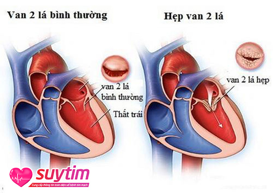 Hẹp van tim là tình trạng các lá van không thể mở ra hoàn toàn khi tim co bóp.