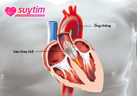 Nguyên nhân hẹp van tim có thể đến từ can thiệp phẫu thuật thay van.