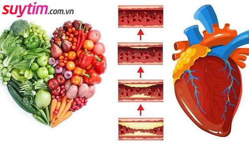 Chế độ ăn uống hợp lý giúp cải thiện bệnh thiếu máu cơ tim 