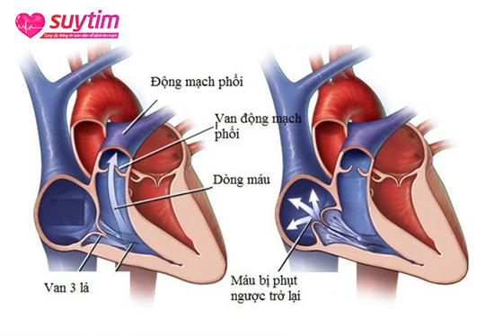 Hở van tim 3 lá nặng khiến người bệnh dễ gặp rủi ro rung nhĩ, suy tim