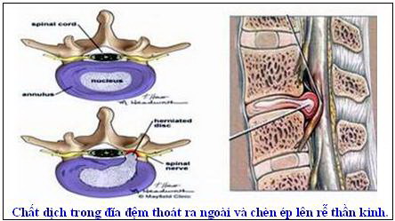 Dùng thuốc trong điều trị thoát vị đĩa đệm như thế nào?