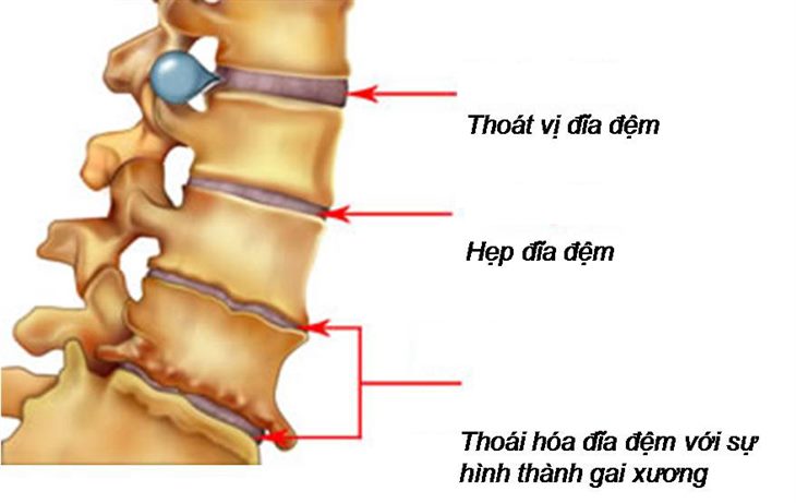 Gai cột sống điều trị thế nào là tốt nhất