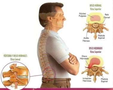 Phòng và trị đau lưng đơn giản hiệu quả
